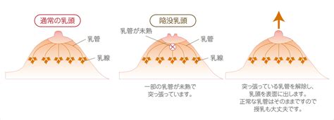 仮性陥没乳首|陥没乳頭・陥没乳首を治す方法、他院修正事例紹介とQ&A 